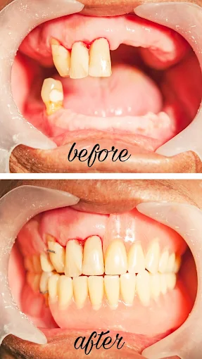 Smile transformation 5