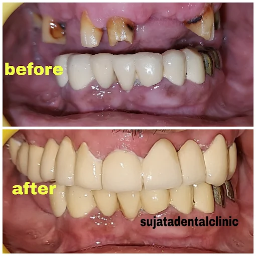 Smile transformation 4